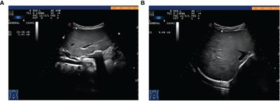 A novel PHKA2 variant in a Chinese boy with glycogen storage diseases type IXa